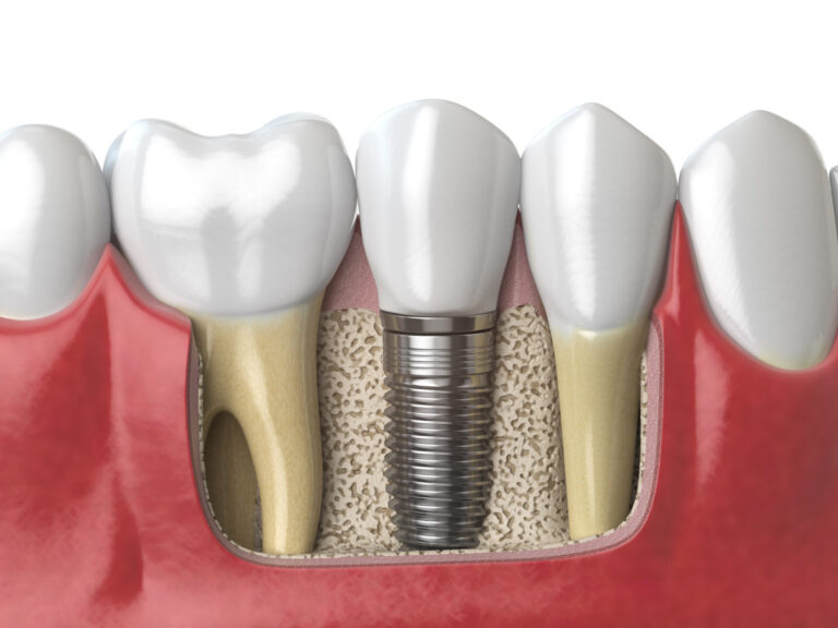 dental implant in bulleen at smile style dental bulleen