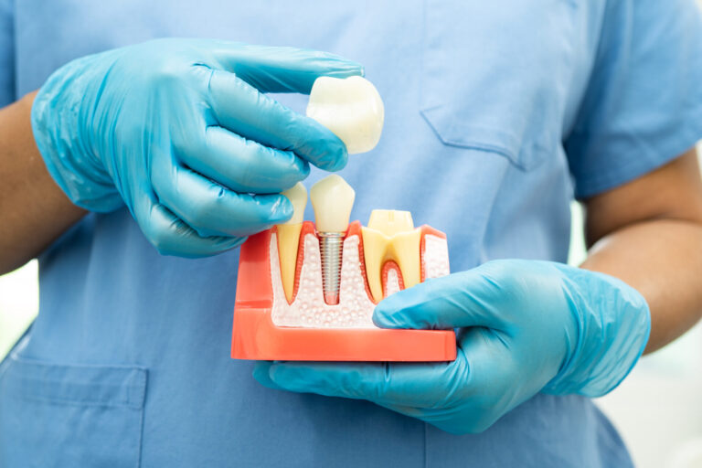 Dental crown Bulleen