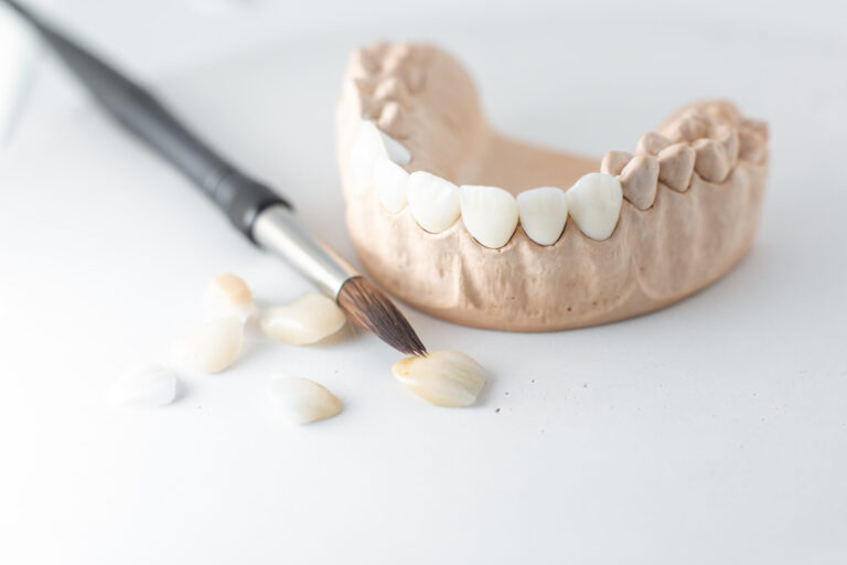 dental veneers in bulleen at Smile Style Dental Bulleen